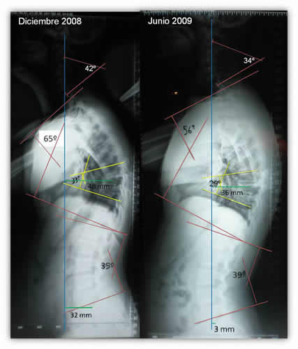 Aumento del Dorso Curvo