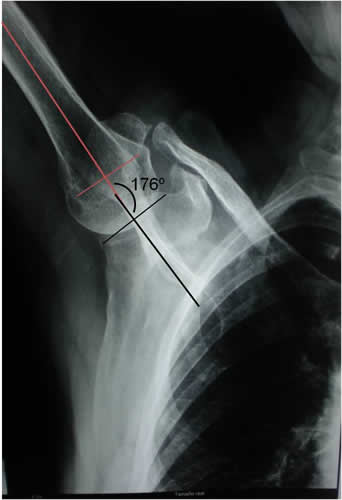 Hombro Doloroso - Síndrome de Impacto