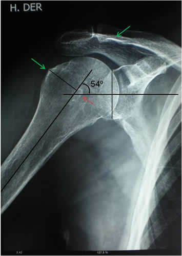 Hombro Doloroso - Síndrome de Impacto
