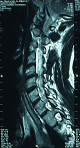 hernia-cervical-cervical