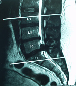 hernia-discal-lumbar