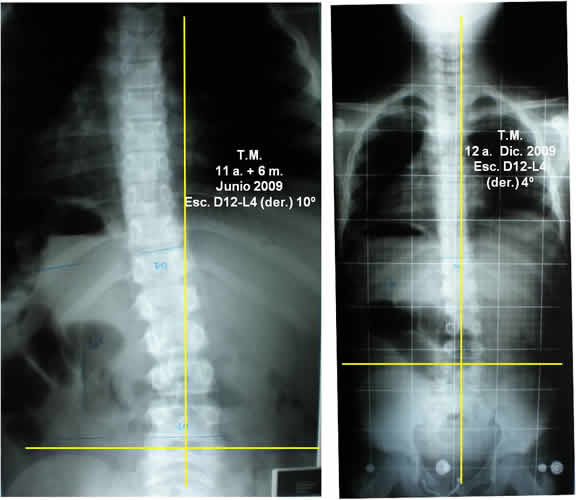 Escoliosis Lumbar