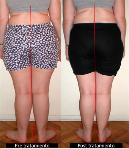 Aumento del Dorso Curvo