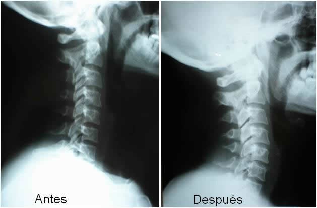 Aumento del Dorso Curvo
